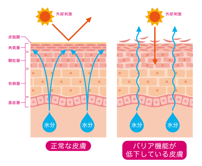 アトピー性皮膚炎の原因