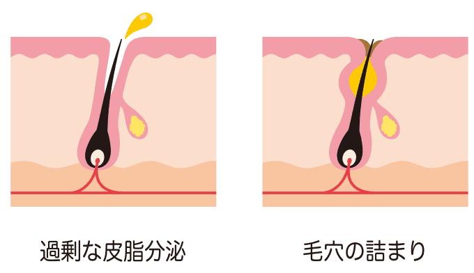 ニキビの原因