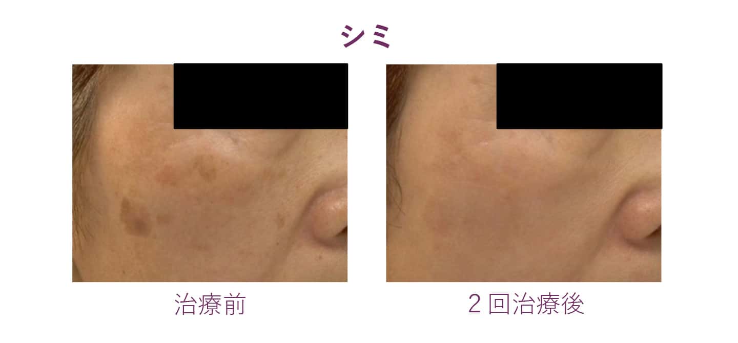 シミの症例写真