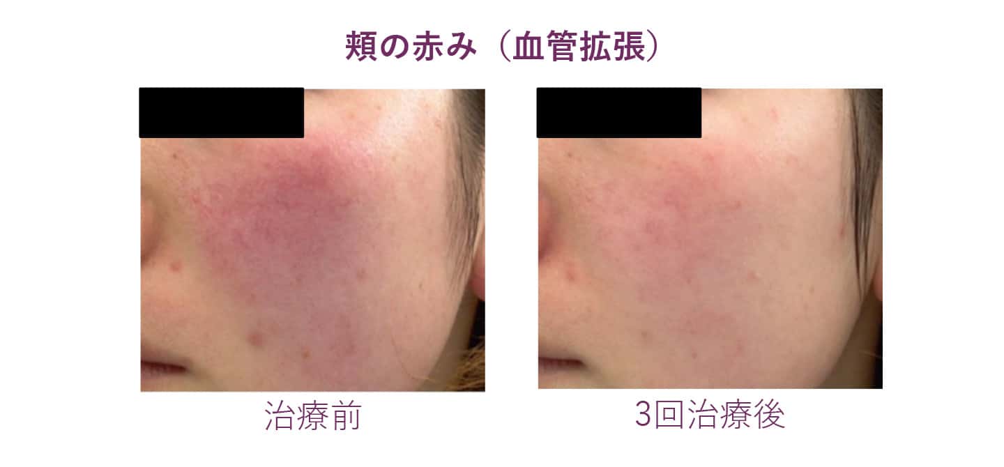 頬の赤み（血管拡張）の症例写真